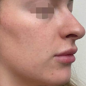 Before After