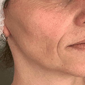 Before After