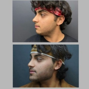 Before After