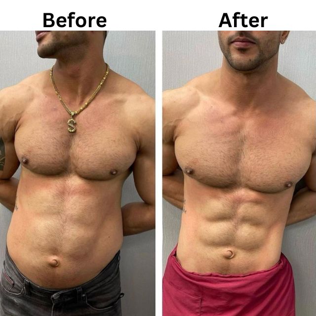 Non Surgical Ab Sculpting